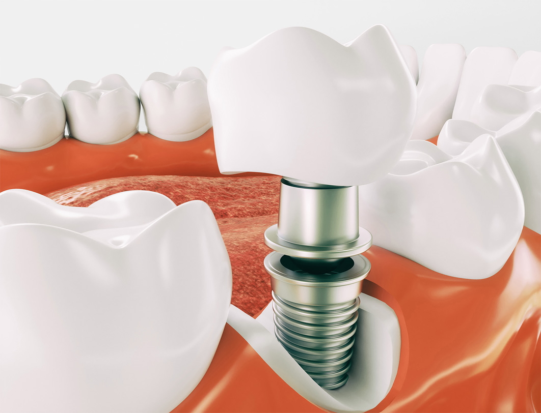 Dental Implants in Fairfield County, CT | Dr. Terence Jackson