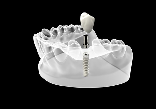 dental implants Fairfield County, CT